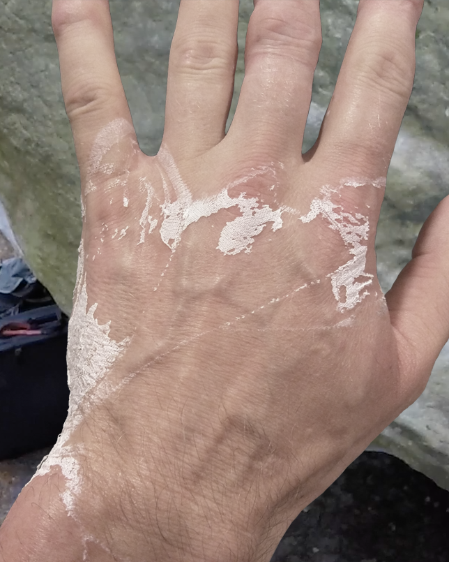 Hand covered with inferior sports tape glue residue.